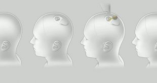 ربط الدماغ البشري بالكمبيوتر ، إيلون ماسك
